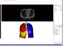 mimics肺结节定位系统应用